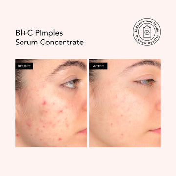 Before and after: facial acne visibly reduced after using Odacite Bl+C Pimples Serum Concentrate on breakout-prone skin.