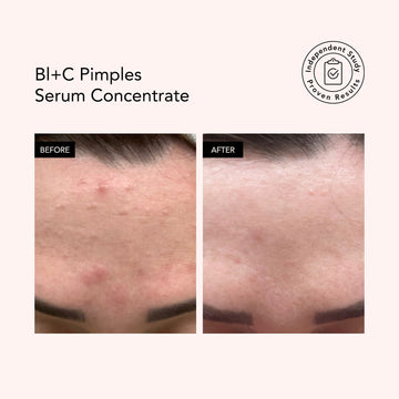 Two photos showing pimple-prone skin before and clearer skin after using Odacite Bl+C Pimples Serum Concentrate, with Proven Results badge.