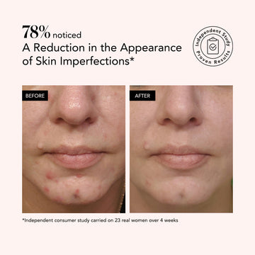 Odacité Clarifying Serum • Salicylic + Hyaluronic Acid shown in before and after images reducing chin and jaw imperfections over 4 weeks.